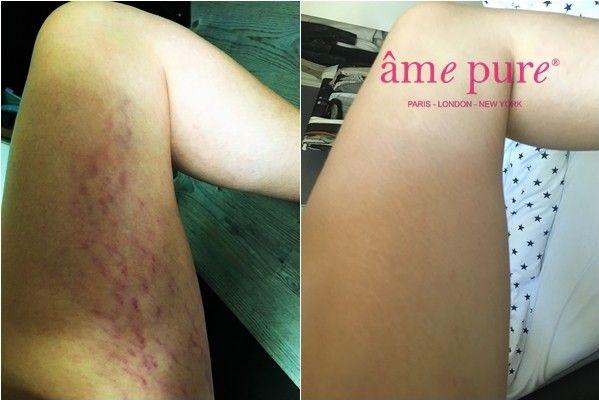 results_after_stretch_marks_eraser_amepure_watermarked
